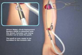 av_fistula