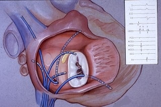 cardiac_electrophysiology